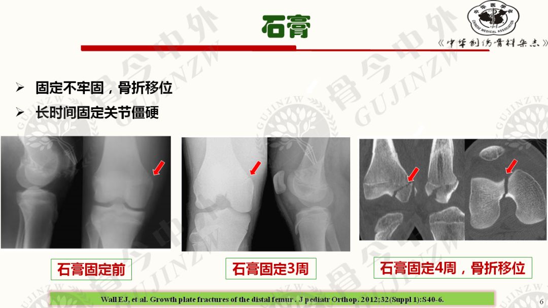 另辟蹊径!骨骺滑动钢板 能否完美解决干骺端骨折问题