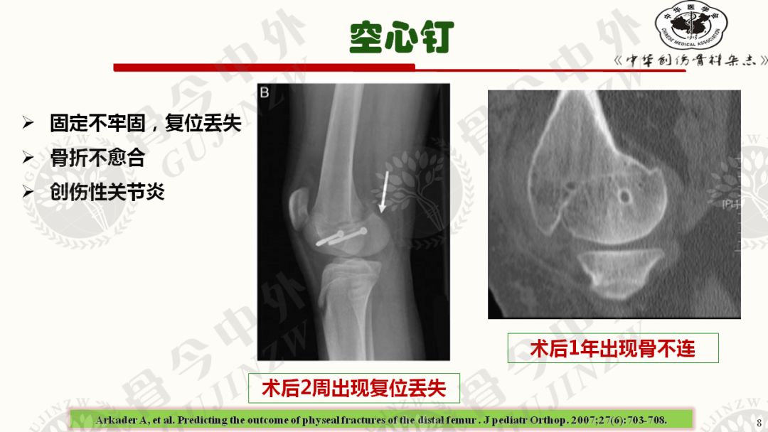 骨今中外 跨骨骺滑动钢板治疗儿童股骨干骺端骨折 骨今中外 骨今中外