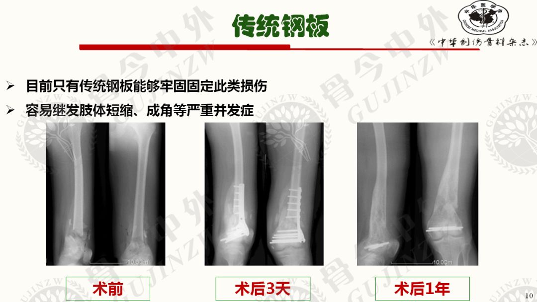 另辟蹊径!骨骺滑动钢板 能否完美解决干骺端骨折问题