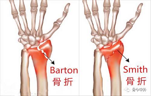 骨科基础 | 桡骨远端骨折分型与掌侧入路