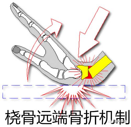 骨科基础 | 桡骨远端骨折分型与掌侧入路