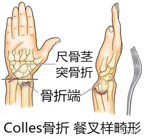 骨科基础 | 桡骨远端骨折分型与掌侧入路