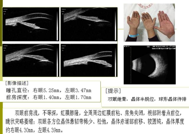 术前ubm及b超检查结果二,手术方案设计思考①如果患者眼轴正常,又