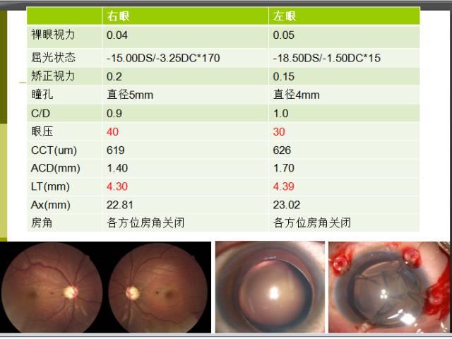 抽丝剥茧大师教您如何智斗白内障