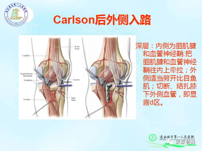骨科教程 | 于吉文教授:胫骨平台骨折mfb分型实战技巧