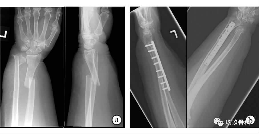 图3 桡骨干骨折合并尺骨远端骨折切开复位,加压接骨板内固定 a.