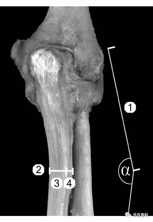 表示尺骨内侧缘到尺骨后缘距离④表示尺骨骨间缘到尺骨后缘距离joyce
