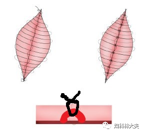 干货子宫疤痕憩室切口选择与缝合的2点思考