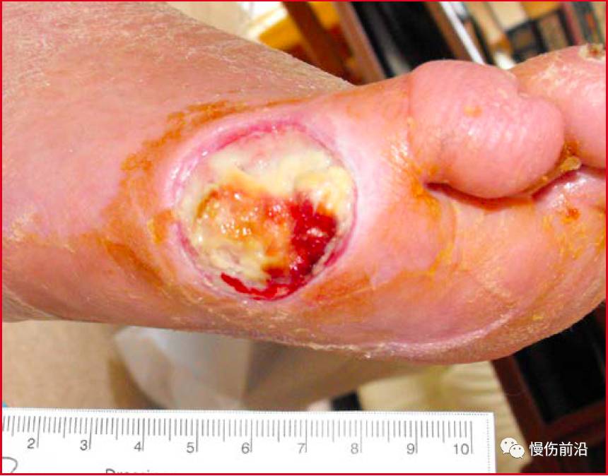 腐肉的存在有多种危害,例如会延迟伤口愈合和肉芽组织生长,妨碍检查