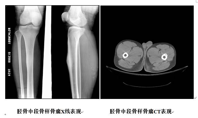 一文读懂!骨样骨瘤的诊断与治疗
