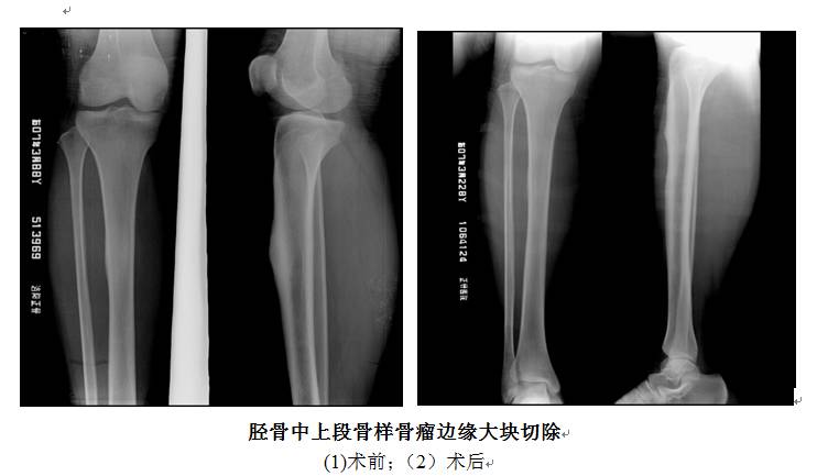 一文读懂!骨样骨瘤的诊断与治疗