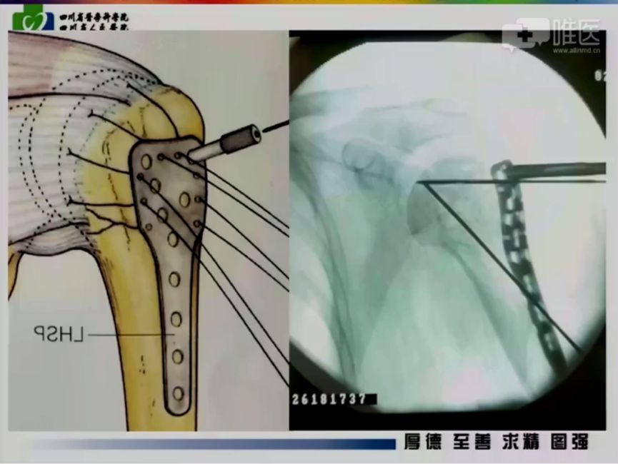 细节决定成败-肱骨近端骨折的钢板内固定手术技巧