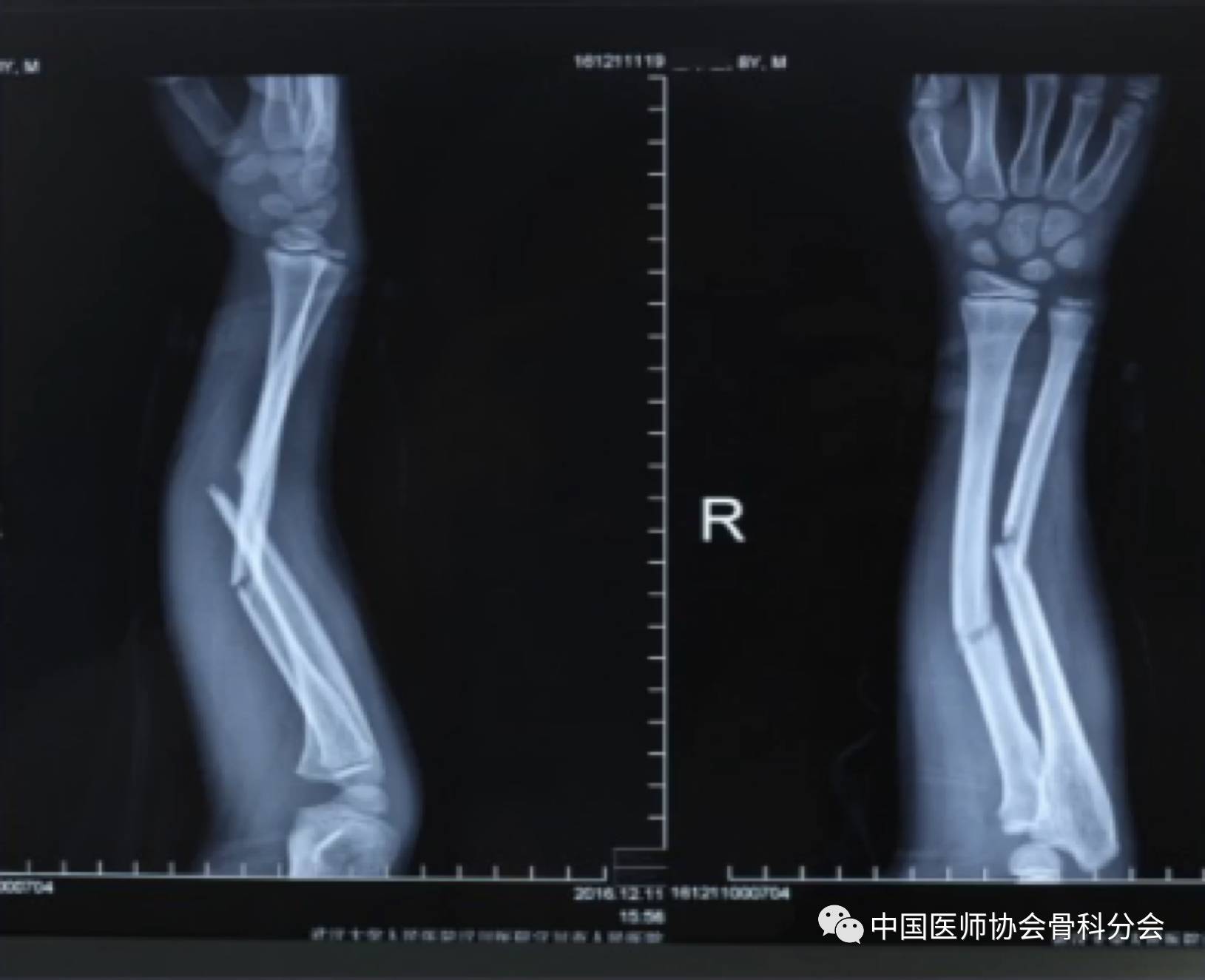 参选作品:闭合复位弹性髓内钉固定治疗儿童尺桡骨骨折