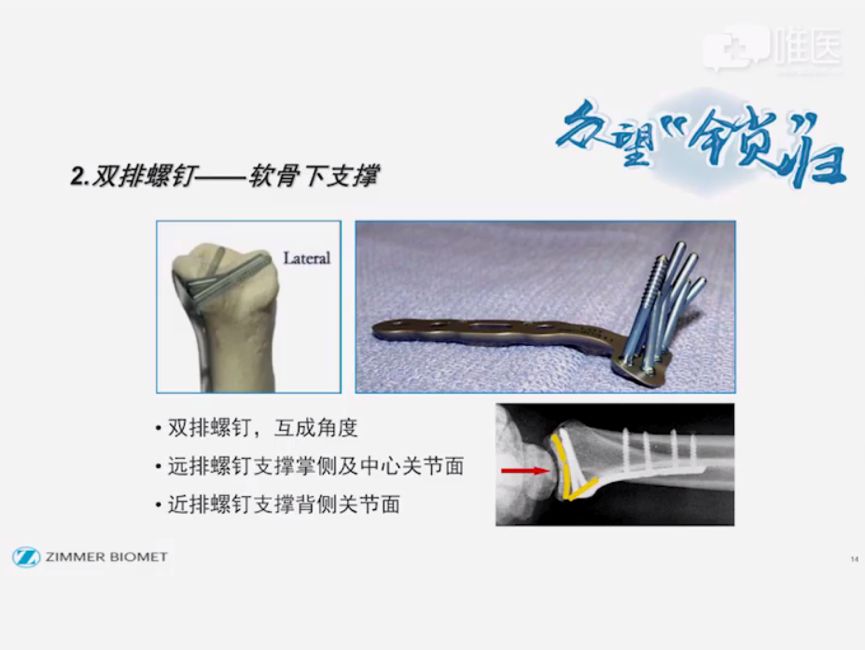 工欲善其事必先利其器-新型dvr系统治疗桡骨远端骨折