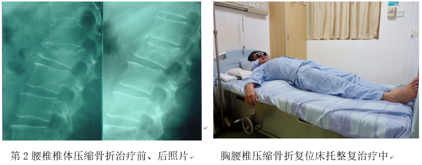 以案说医彭力平治疗腰椎椎体压缩性骨折骨痿骨质疏松症经验