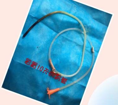 怎么拔鼻腔引流管胃管术（二）_https://www.jmylbn.com_新闻资讯_第44张