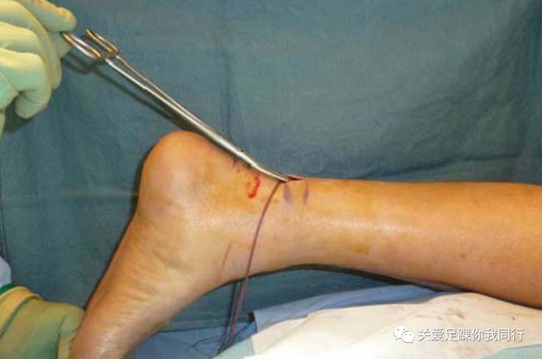 e 跟腱近端采用改良bunnel缝合方法:15#穿刺针在腓肠神经下方由外侧