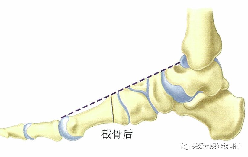 高弓足畸形诊治与病例分享