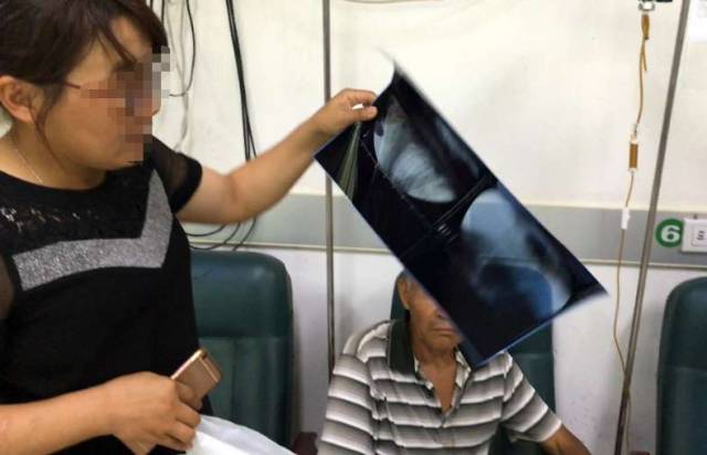 男子吃苋菜直接下咽 结果吞进2个鱼钩卡在咽喉