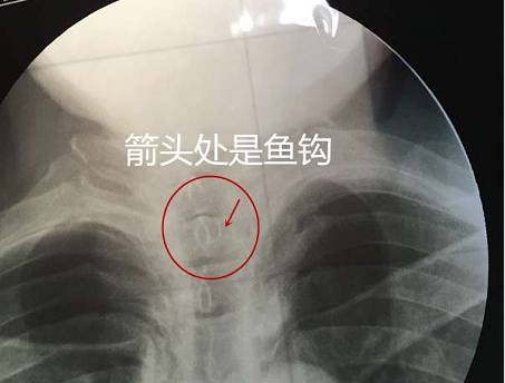 男子吃苋菜直接下咽 结果吞进2个鱼钩卡在咽喉