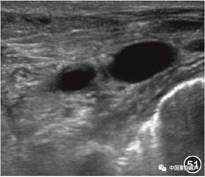 图51 锁骨下动,静脉超声图