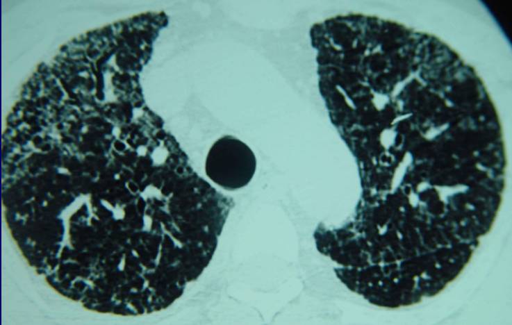 图24:小叶中心性肺纤维化(acif)