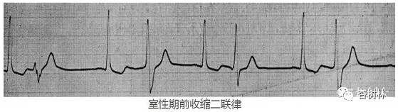 图二为洋地黄中毒的频发室性期前收缩 奎尼丁