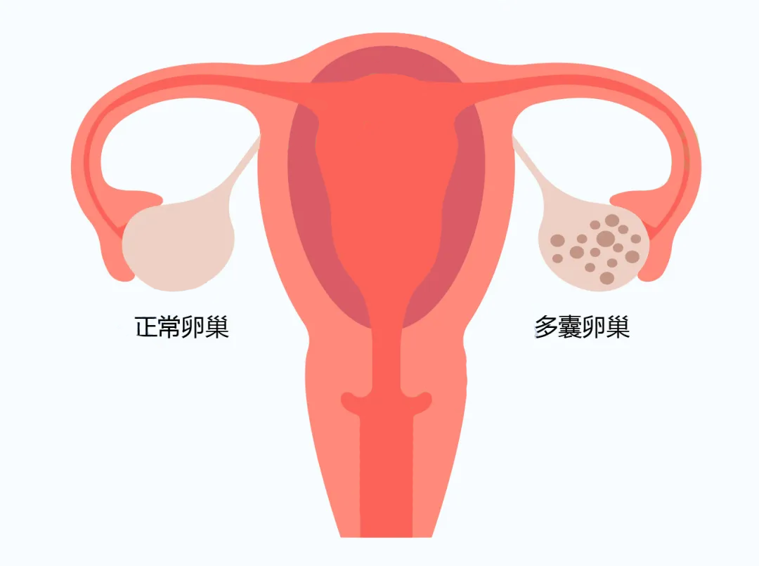 输卵管堵塞会影响试管成功率吗？思普乐试管婴儿专家解析！