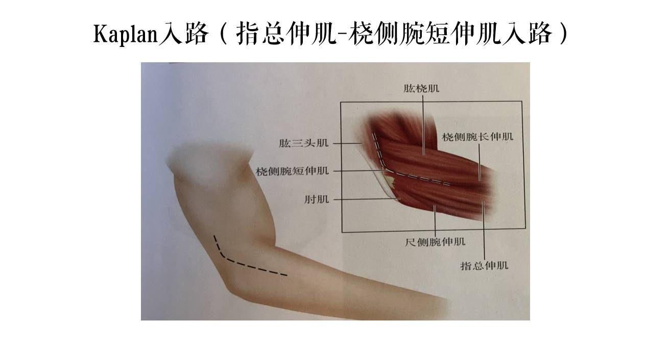 做好一台桡骨头骨折orif术的必备干货 | 张堃教授讲