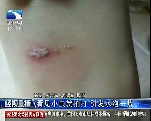 女孩睡梦中觉得脖子痒随手一拍 一觉醒来已毁容