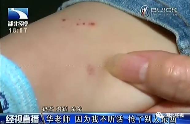 武汉女童疑在幼儿园遭针扎！监控视频却离奇消失