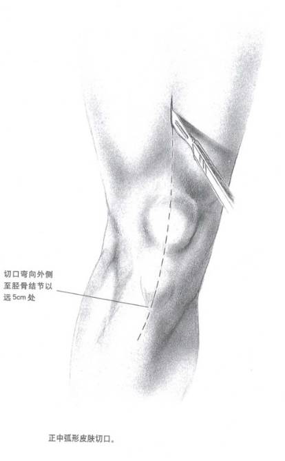 远端越过gerdy氏结节中点到达前室筋膜,止于胫骨结节以远3cm处