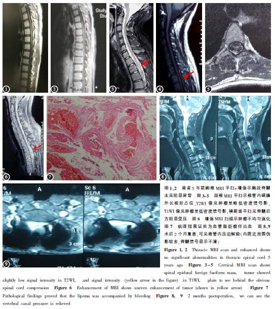 外科:这种脂肪瘤竟然可以严重到导致截瘫?