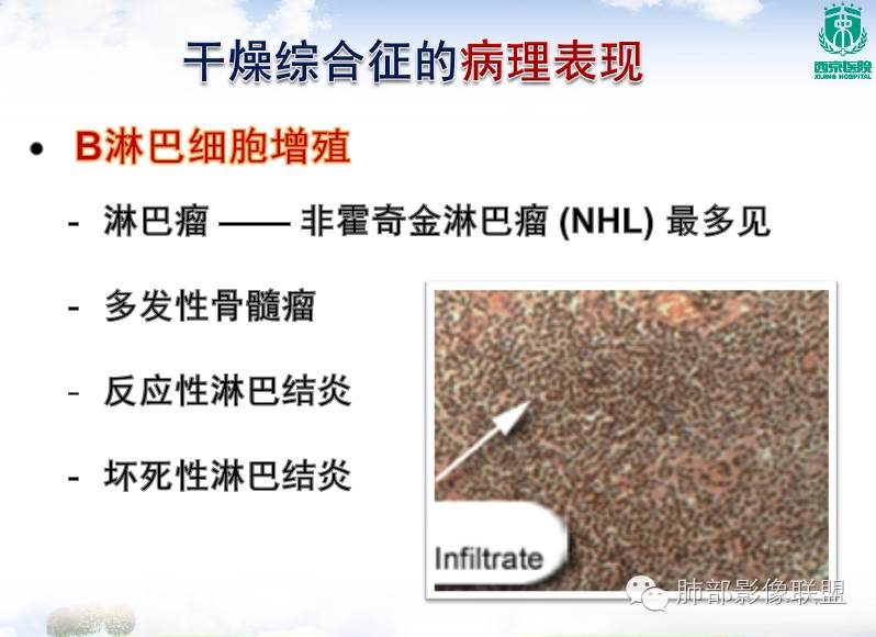 原发性干燥综合症的肺部损害