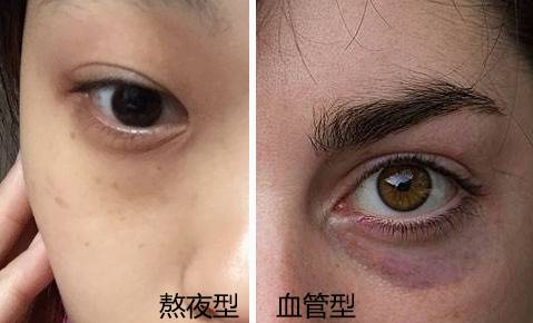 年纪轻轻不要小看这些眼周问题