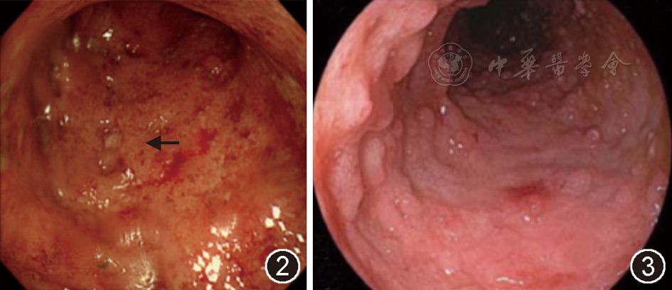【病例析评】脓血便-发热-巨细胞病毒性结肠炎