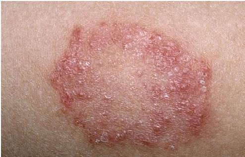 7        皮肤问题 寄生虫引起的炎症可以导致皮肤问题,如