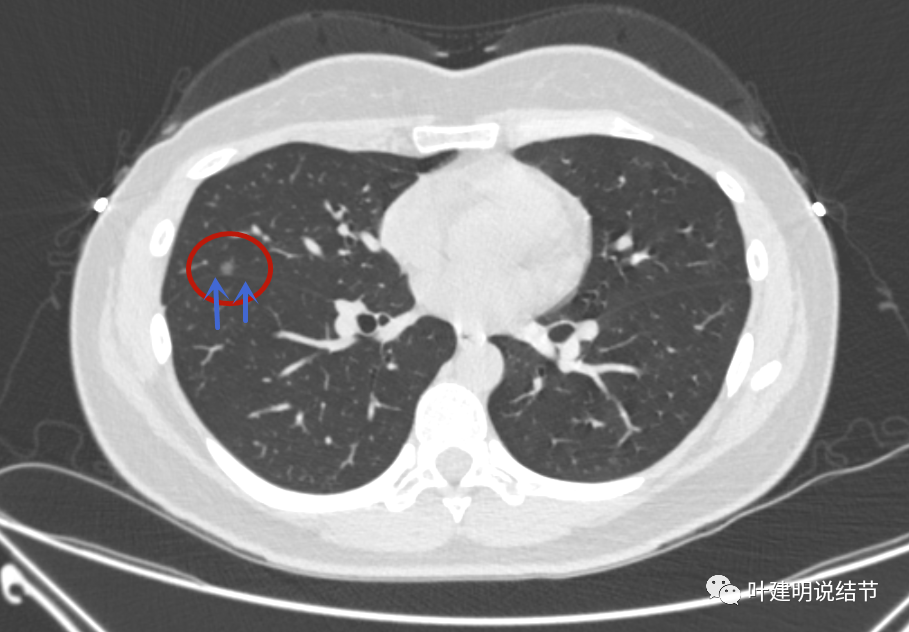 左上叶舌段第7处(粉色):微小淡磨玻璃结节,考虑aah可能性大;右中叶第8