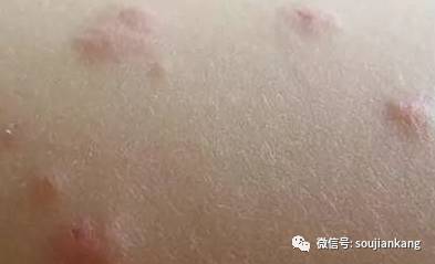 皮肤病的种类图片之皮炎湿疹图片大全