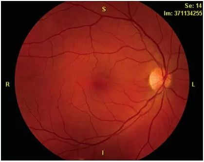 右眼眼底检查可见视盘颞侧苍白