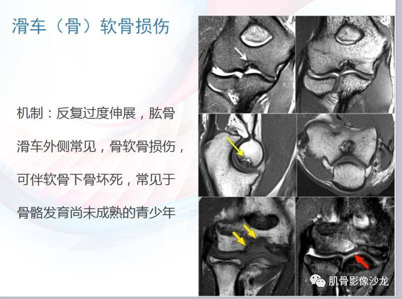 平片,ct,核磁都有相应类似的表现 最后这个是比较少见的滑车软骨损伤