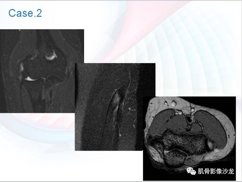 病例1,我们看到这个患者的冠状位t1和t2压脂图像上,肱骨外上髁伸肌总