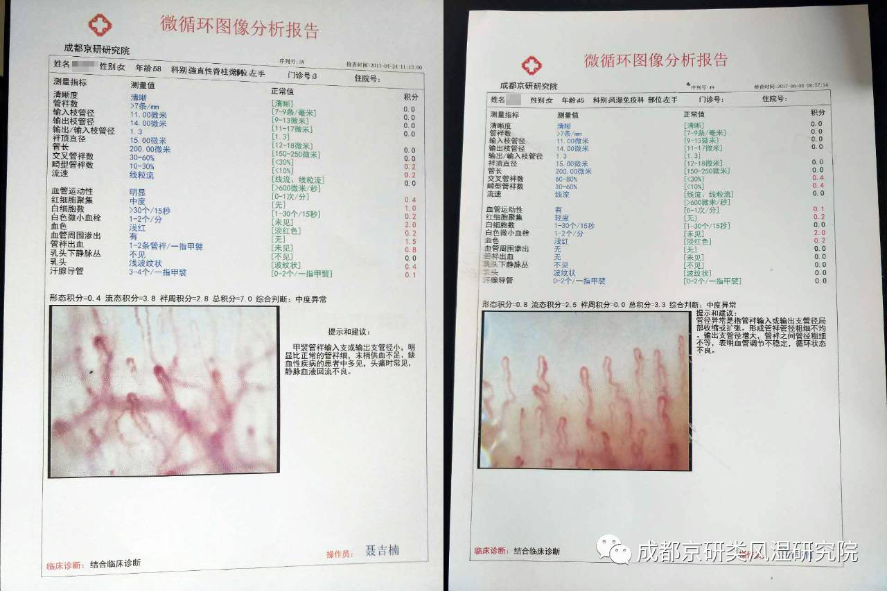 【专科医院药物专属检测设备】微循环障碍检测仪 ——准确辨别微循环