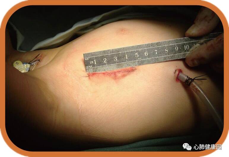 即在保证手术安全的前提下尽可能缩短切口长度,如右前外侧小切口,腋下