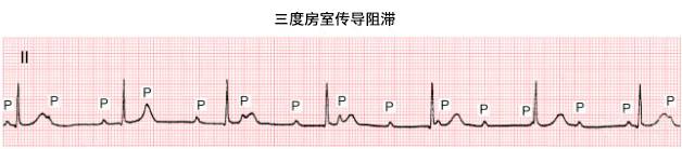 看心电图揪「拦路虎」:谈谈房室传导阻滞