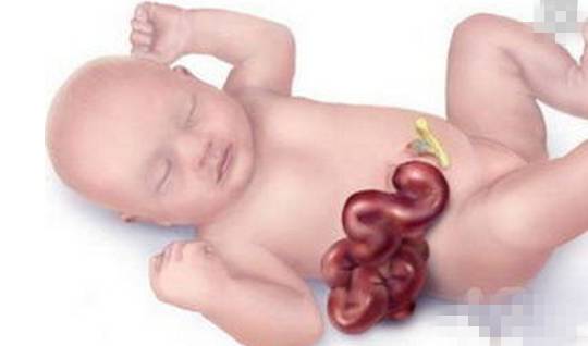 广西两个婴儿,一个肚子膨胀长出“小西瓜”,一个肠子收不回肚子里;都是因为妈妈怀孕时没注意产检.