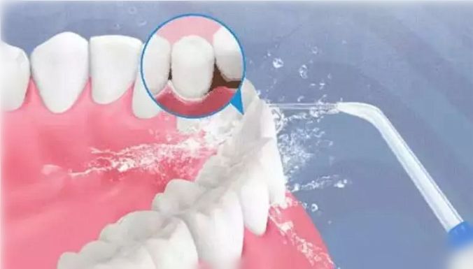 怎么选洁牙器械【诺美口腔·4店适用】49.9元享洁牙套餐：口腔健康档案、全口口腔问题诊断、无菌治疗器械、成人超声波洁牙...._https://www.jmylbn.com_新闻资讯_第27张