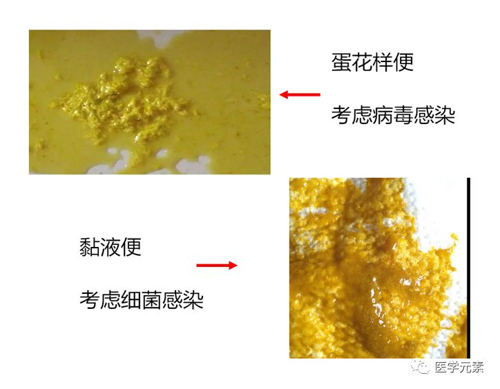 为感染性的和非感染性的 ,而儿童腹泻中,病毒感染和细菌感染较为多见