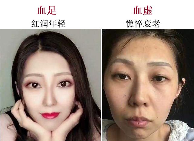 血虚的女人老得快脸色黄皮肤暗易失眠90的女性都中招了