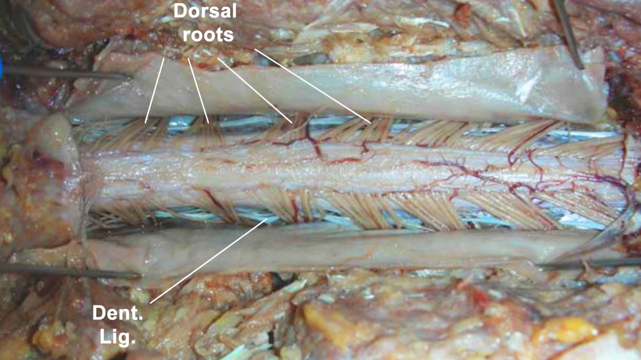 蛛网膜附于硬脊膜内面,中间层与蛛网膜和软脊膜相连,后背分隔很容易